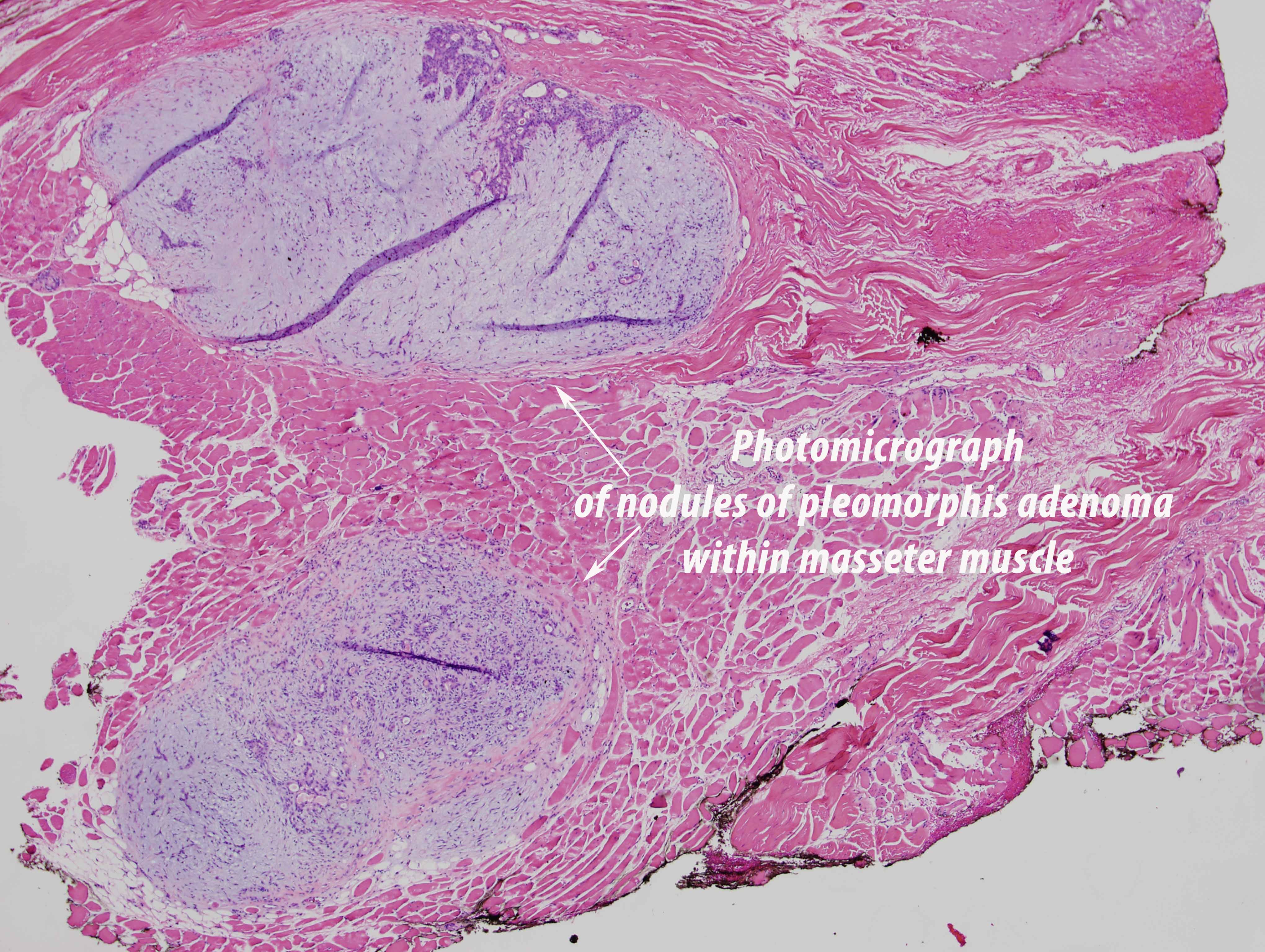 Pleomorphic Adenoma Parotid